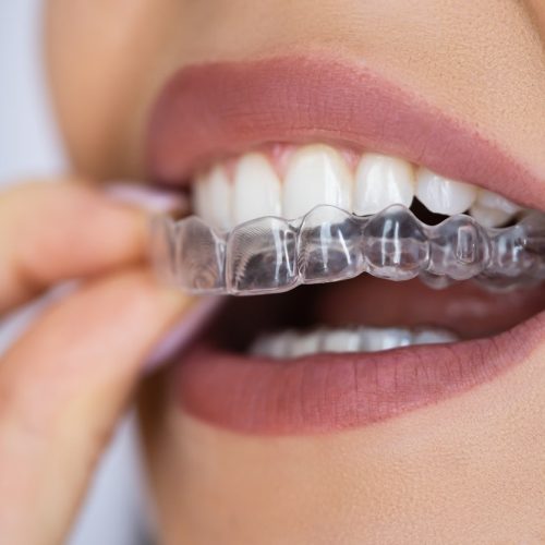 Close-up of patient wearing clear aligners during Invisalign orthodontic treatment at Boyd Orthodontics in Glen Allen, VA 23059