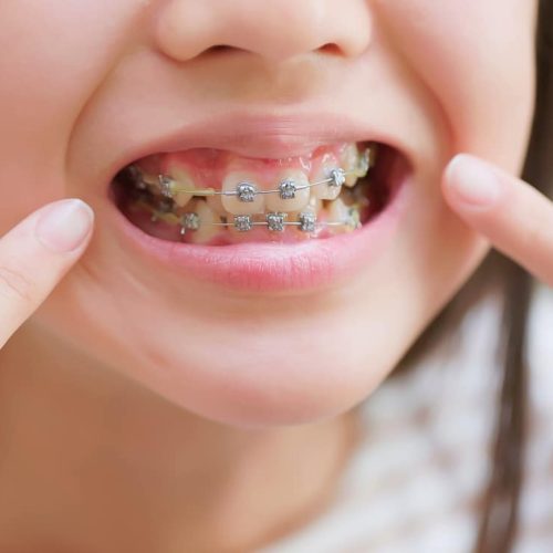 Close-up of young patient smiling with traditional metal braces during orthodontic treatment at Boyd Orthodontics in Glen Allen, VA 23059